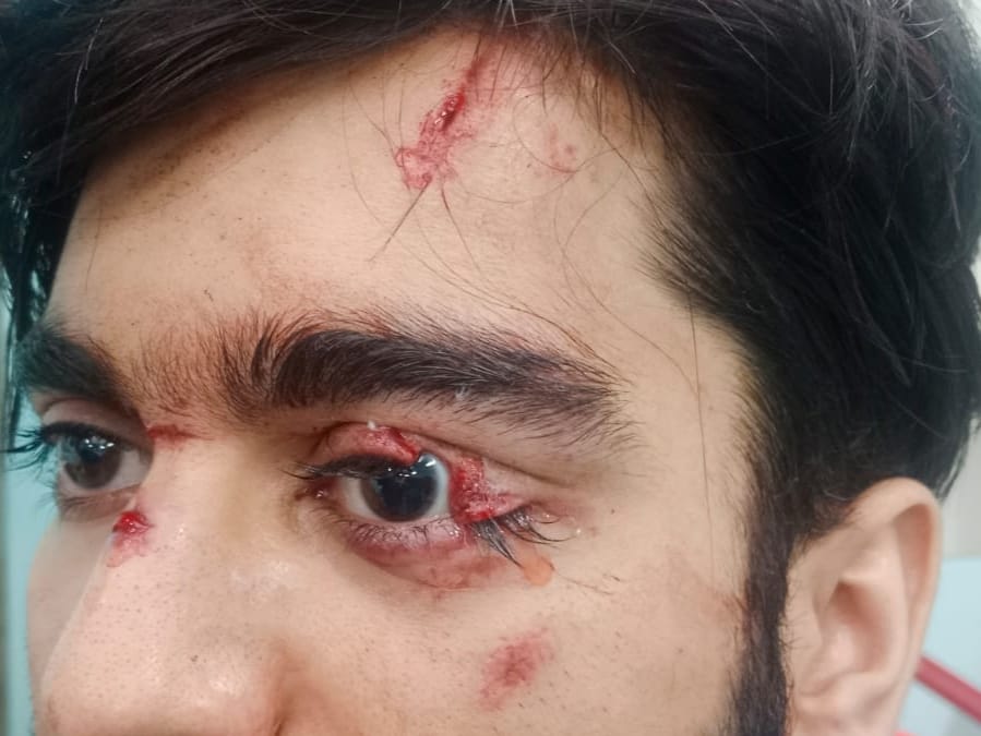Lid laceration repair photo